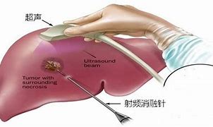 周易预测肝病的方法